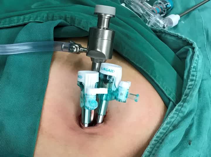 单孔腹腔镜手术疤痕大吗,四孔腹腔镜胆囊切除术