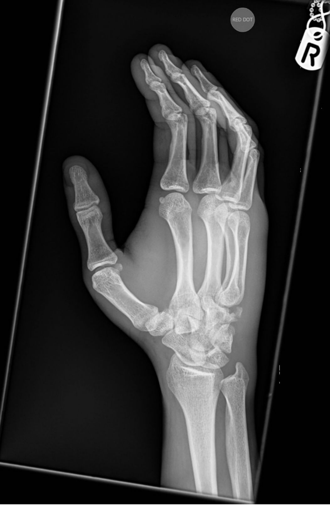 右手桡骨疼痛,右手钩状骨骨折20天