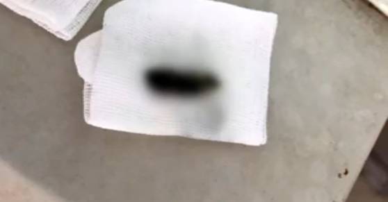 棉签抠耳朵导致癫痫,警惕掏耳朵竟暗藏这些危险