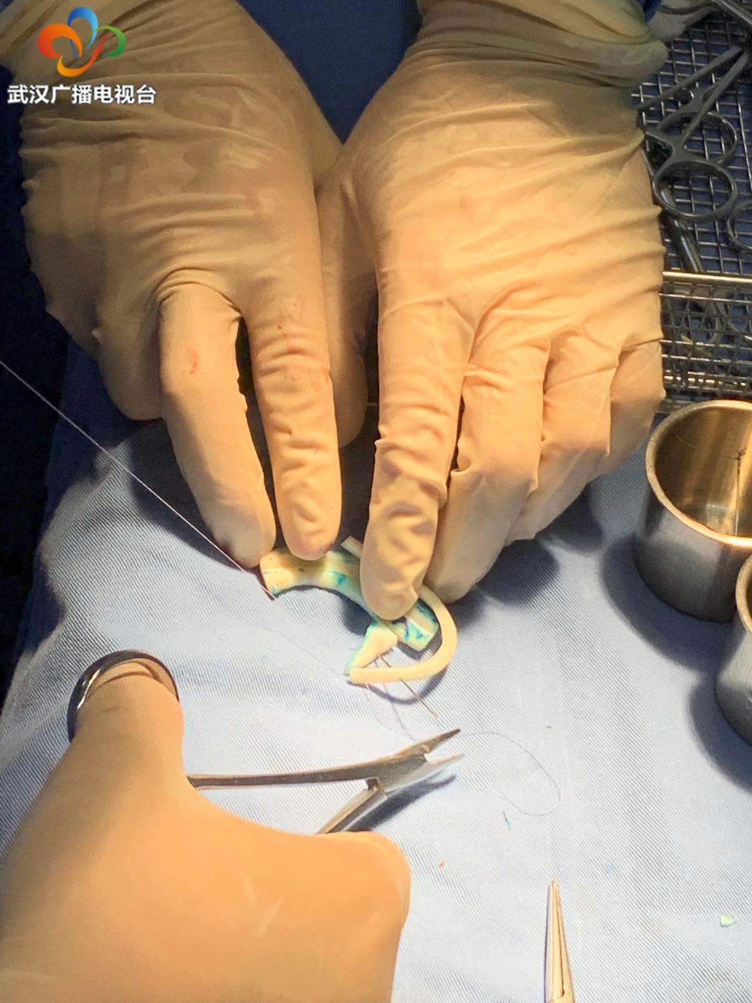 男童先天右耳缺失,突发疫情为“补耳”增添难度