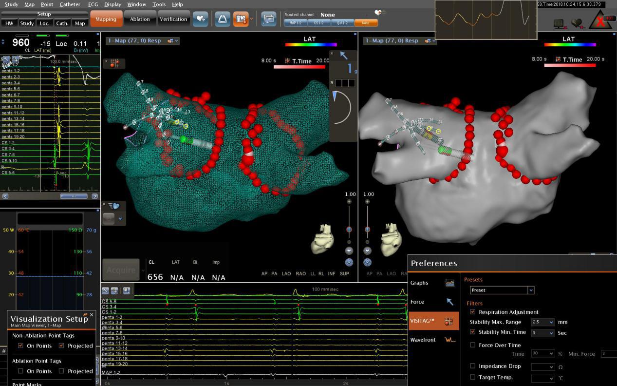 唐山心脏射频消融术哪里做的好,导管冷冻消融治疗房颤全过程