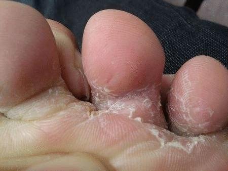 冬天脱鞋脚臭怎么办,长时间没办法脱鞋怎么防止脚臭