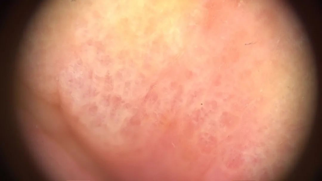 长痒痒的小水泡可以挤吗,小水泡很痒怎么快速止痒