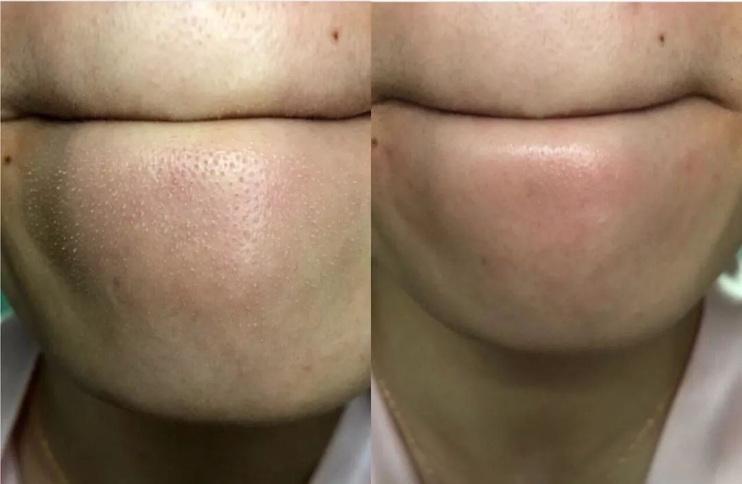 挤痘痘出来的白色长条状是什么,痘痘黑头挤出白颗粒