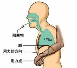 气道异物患者麻醉,小儿气道异物麻醉