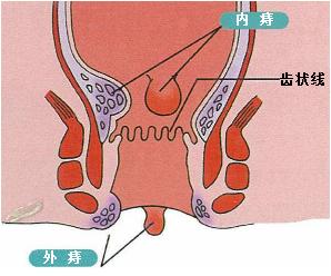 超声多普勒痔动脉结扎术利弊,超声刀治疗痔疮还需要内扎吗