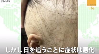 日本16岁美少女偶像歌手脱发到光头！“沦为”假发模特后的她，没有忘记自己甜美的笑容...