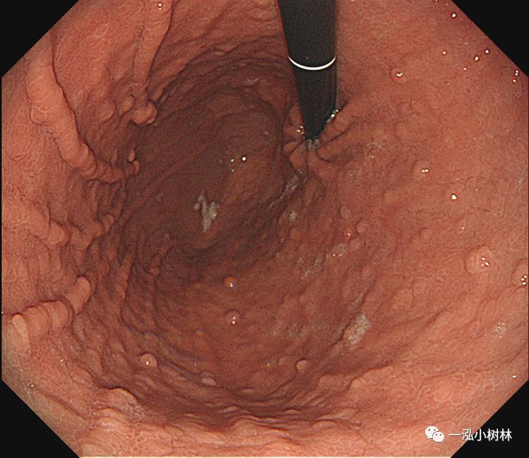肠上皮化生做什么检查,肠化生内镜看得出来吗