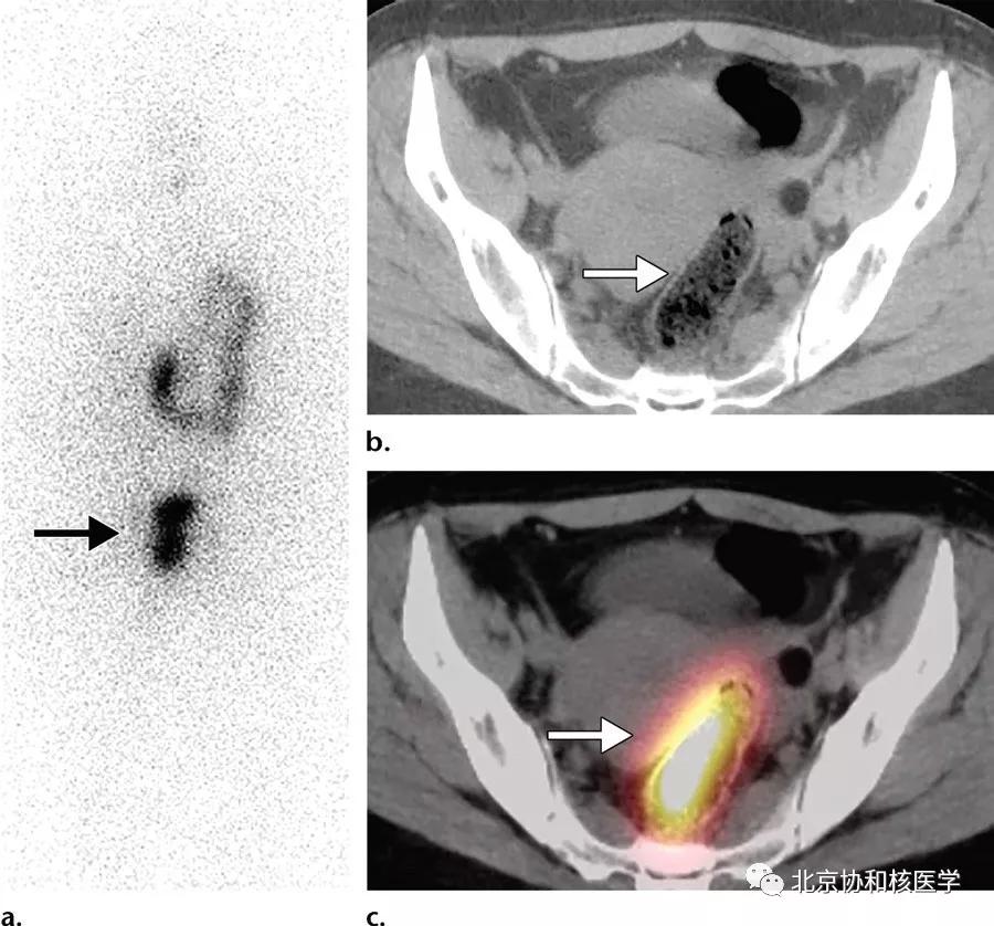 碘扫描最坏的结果,放射性核素扫描可以鉴别诊断吗