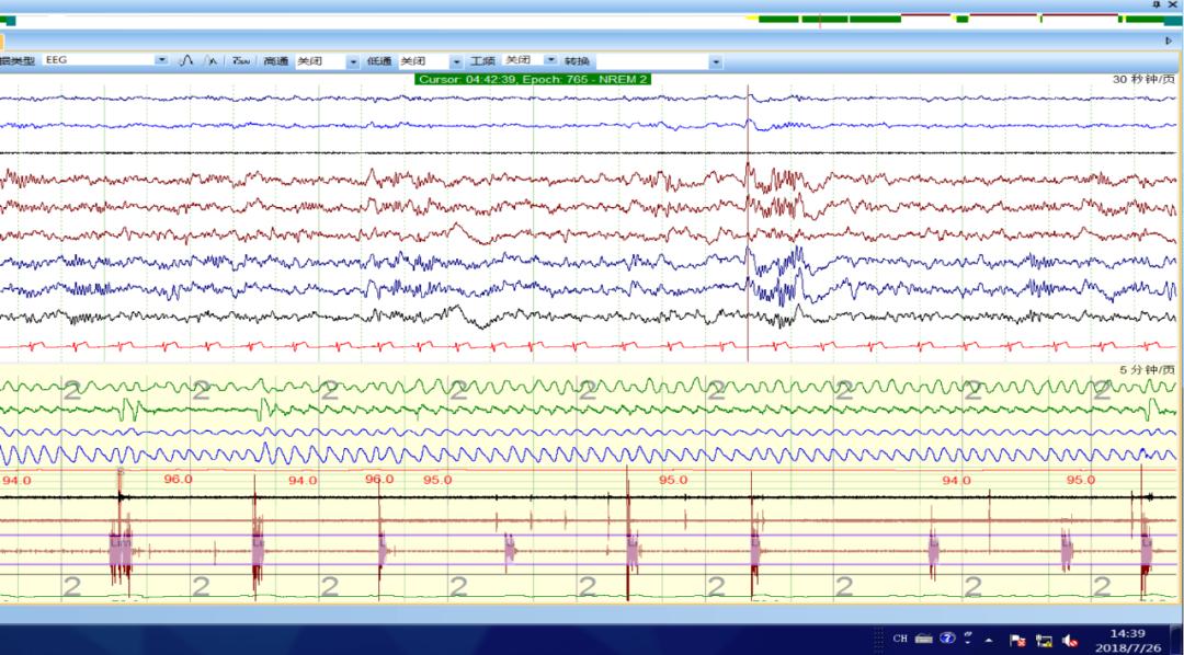 「病例实战」不安腿综合征的诊断策略