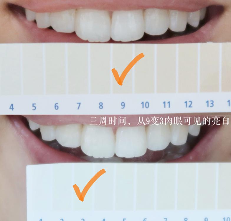 牙齿太黄简单的方法不用花钱,牙齿黄除了洗牙还有什么办法