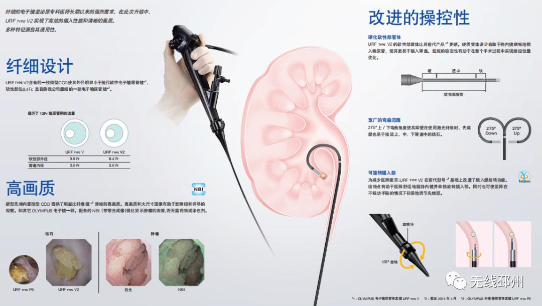 输尿管软镜微创,邳州医院泌尿科