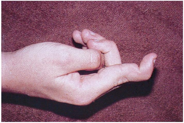 肩部运动损伤的检查4个方法,肩部各种损伤