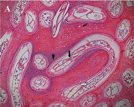51岁老刘臀部包块不断长大，华山感染专家：是非洲来的“偷渡客”