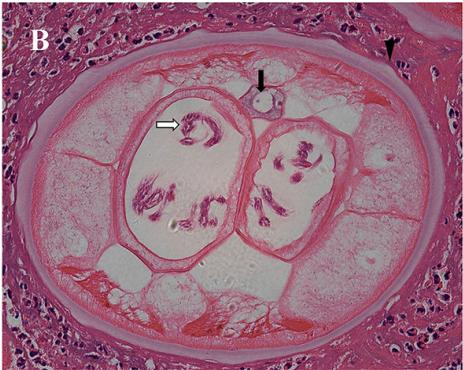 51岁老刘臀部包块不断长大,华山感染专家:是非洲来的“偷渡客”