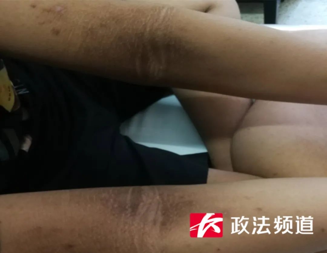 男孩14岁皮肤有黑斑是怎么回事,13岁的男孩皮肤越来越黑怎么回事