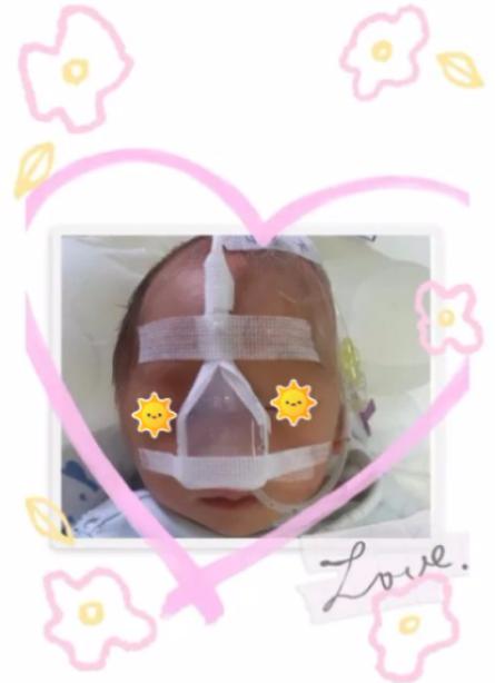 自制新生儿防护面罩,新生儿自制氧气头罩