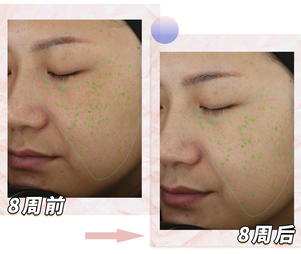 爱长斑的女人怎么办,女生长斑