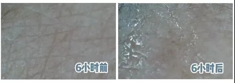 抬头纹眉间纹怎么去除,眉间纹抬头纹去除最好的方法