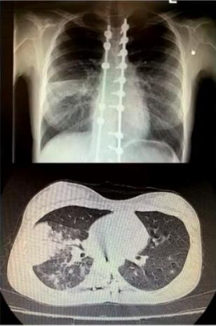 支原体肺炎症状中医诊治,成人肺炎支原体肺炎诊治专家共识