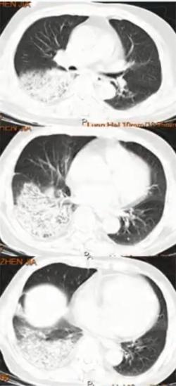 成人肺炎支原体肺炎诊治专家共识,2023肺炎支原体感染中药诊治指南