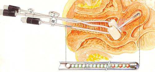 德州市癌症精准放疗,癌症立体定向放射治疗医院