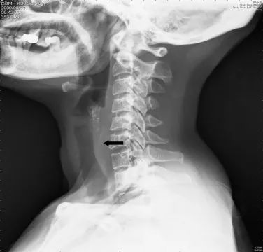 医生们曾在人体内取出过多少神奇的物件？