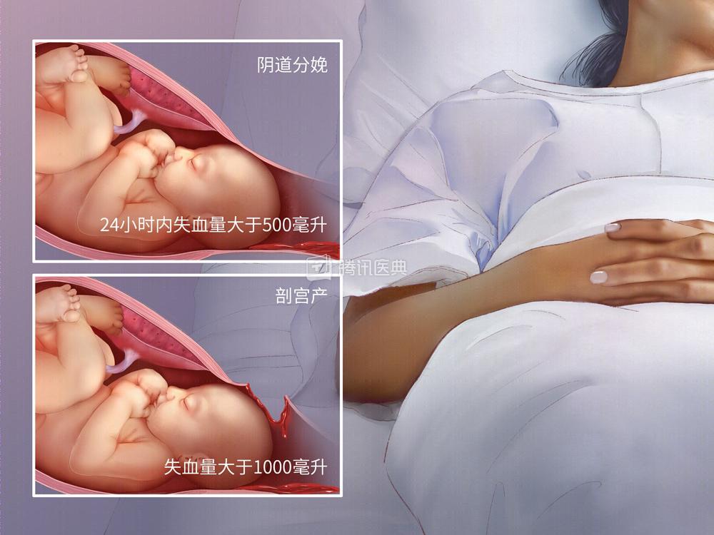 产后大出血孕妇后续,孕妇产后大出血8000ml