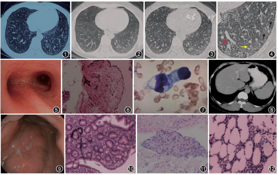 贫血病例讨论,临床各类贫血的原因及防治