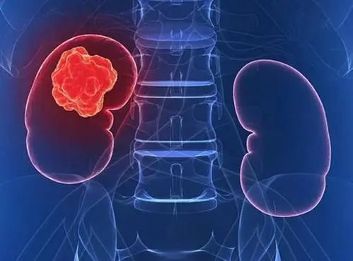 【警惕】耄耋老人患巨大肾癌，佛中医泌外团队3D腹腔镜微创治愈