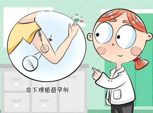 济南皮下埋植避孕针,皮下植入剂避孕怎么做