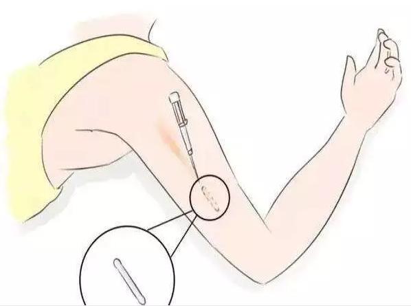 济南皮下埋植避孕针,皮下植入剂避孕怎么做