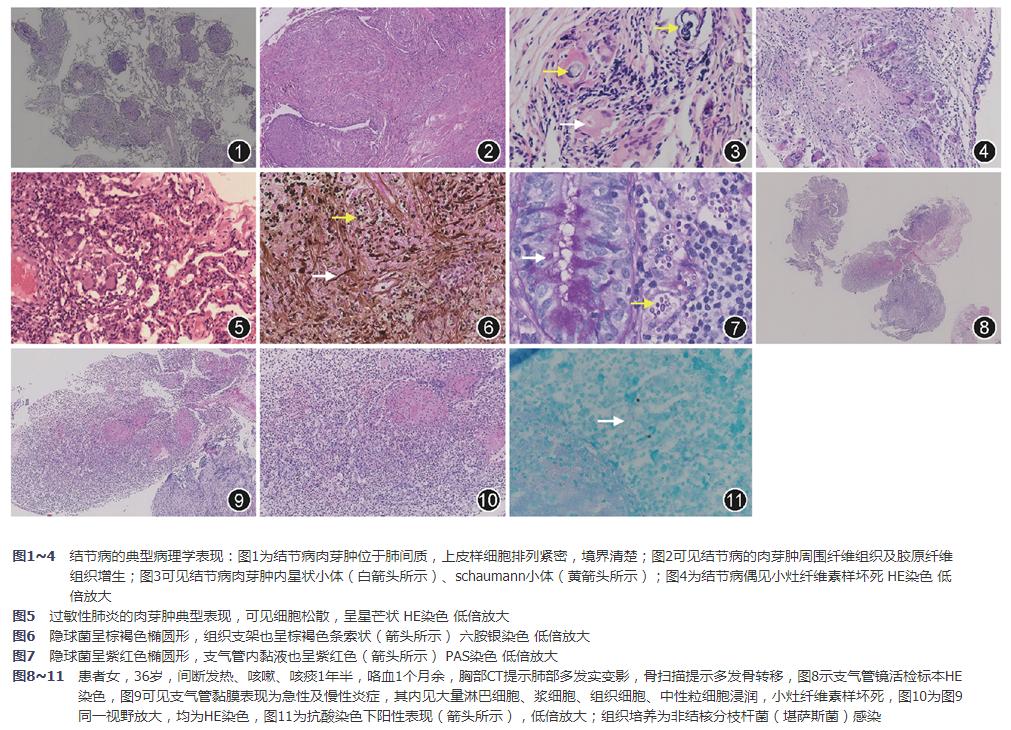肺嗜酸性肉芽肿的常规治疗方法,间质性肺疾病应做哪些检查