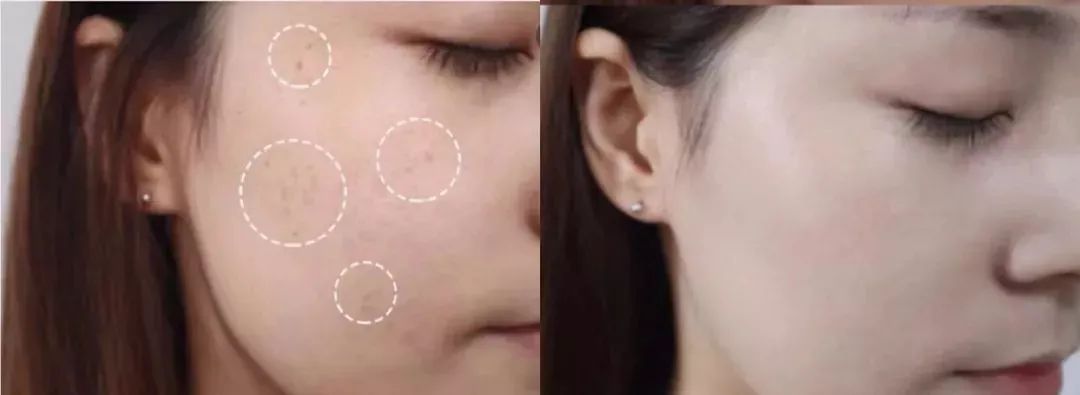 花了3万做激光，才彻底懂了：医生为什么劝你别去斑