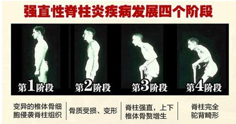54岁得强直性脊柱炎怎么治,50多岁男性还有强直性脊柱炎吗