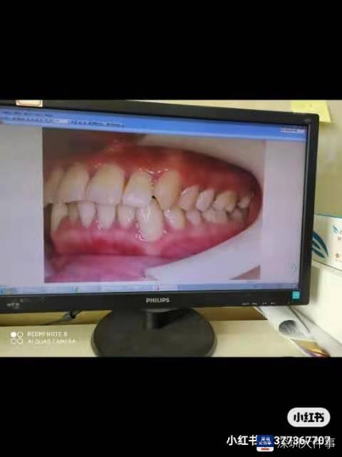 轻度中度重度矫正牙齿,修复牙龈萎缩牙缝大的牙膏靠谱吗