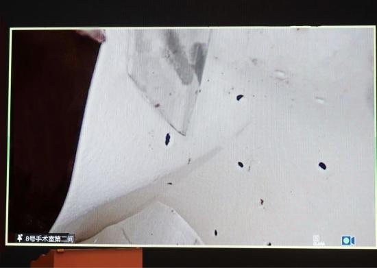 复合生物补片成未来发展方向迈入腔镜临床试验新阶段