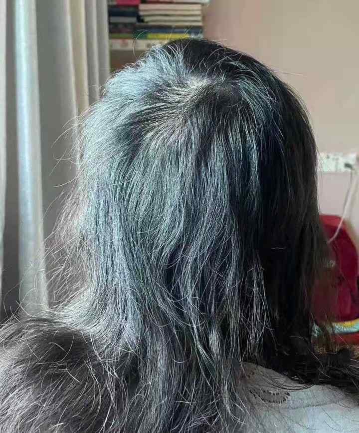 “我控制不住啊！”14岁漂亮女孩硬生生把自己拔成秃顶，真相令人唏嘘