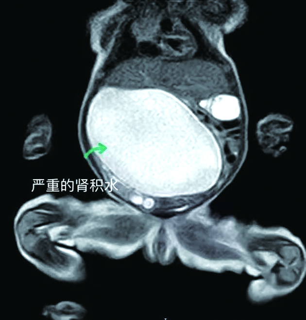女婴腹中有个“重复肾”，医生成功将“地雷”摘除