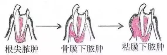 牙齿痛怎么办教你一招搞定牙痛,牙痛怎么样判断牙齿什么问题