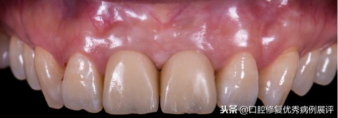 展评优秀病例赏析|Asc全瓷角度基台一体冠进行种植前牙美学修复