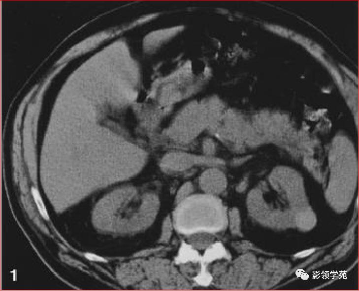 肾脏囊性肿块的影像学特点,肾脏典型病理图片及解析
