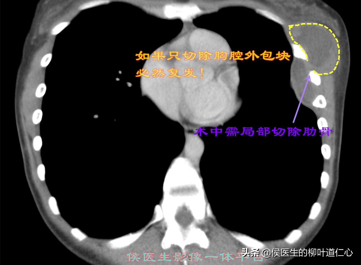 结核杆菌会引起肺结节吗,肺结节诊断为肺结核