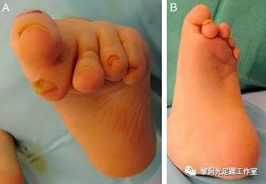 伊里扎洛夫外固定架治疗足部畸形,足部畸形矫正的技巧