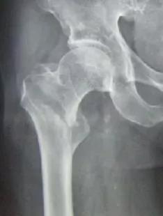 股骨大转子骨折手术后淤血正常吗,股骨粗隆骨折出血多吗