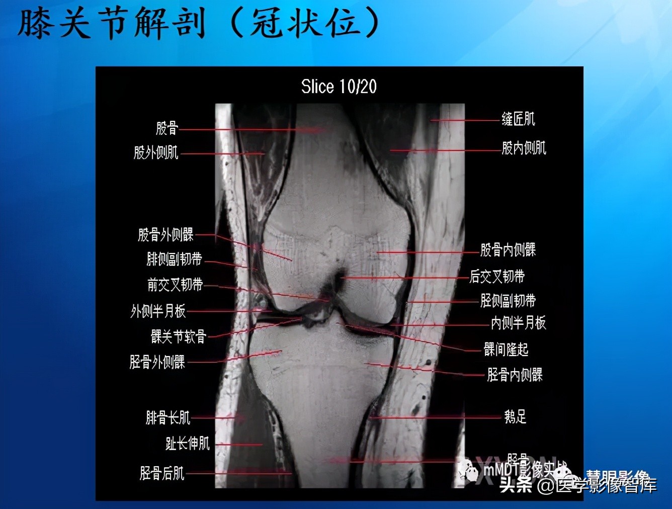 膝关节半月板损伤的解剖结构图,半月板mri解剖图解