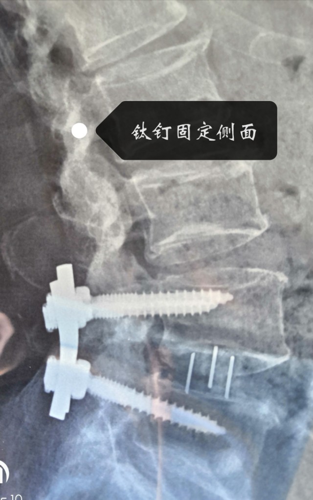 腰椎管狭窄康复日记,腰椎狭窄手术住院时间
