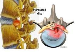 腰椎间盘突出正确锻炼方法,热敷对腰椎间盘突出有用吗