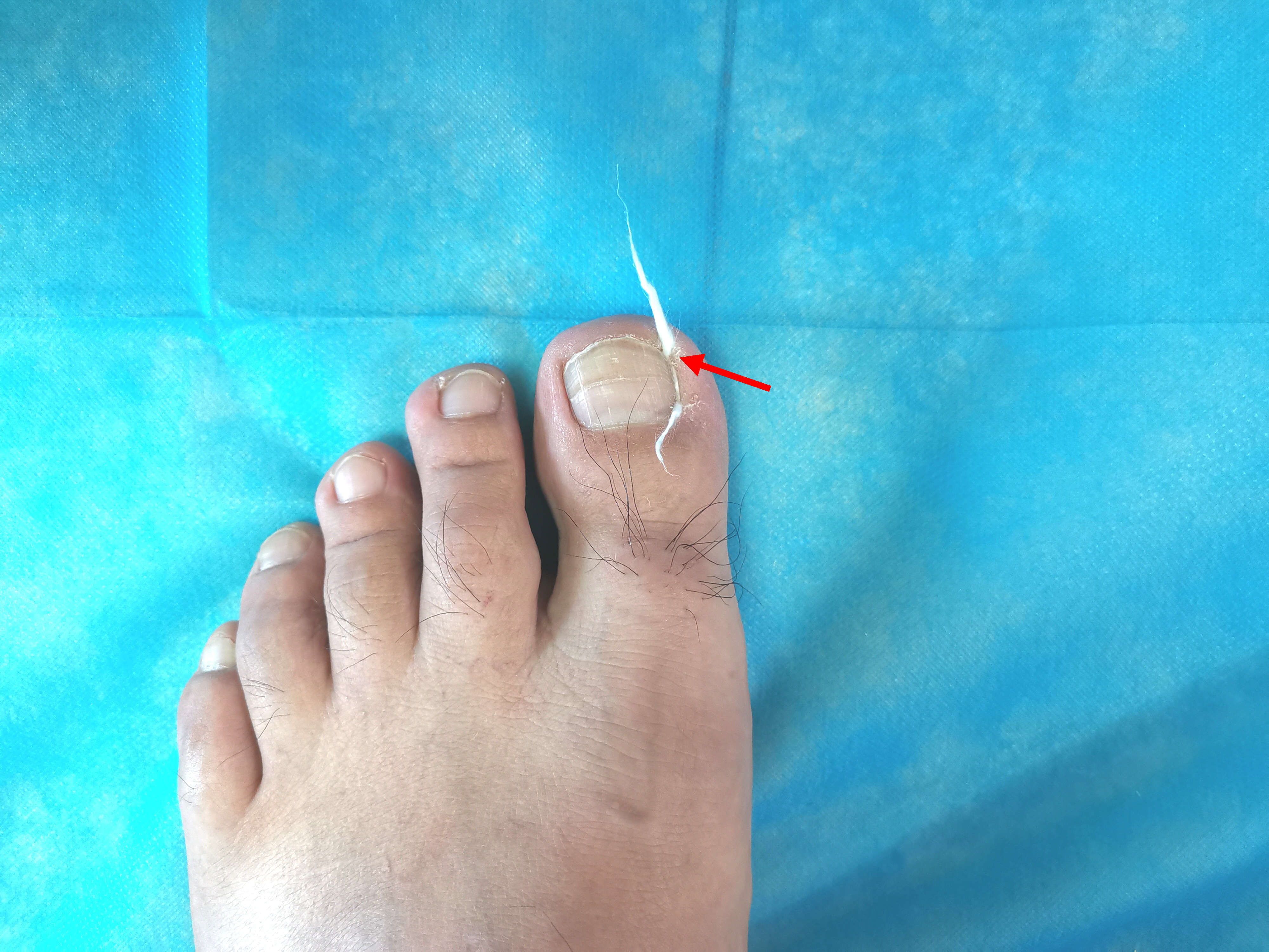 甲沟炎塞棉花能永久治疗甲沟炎吗,如何用棉花棒治疗甲沟炎