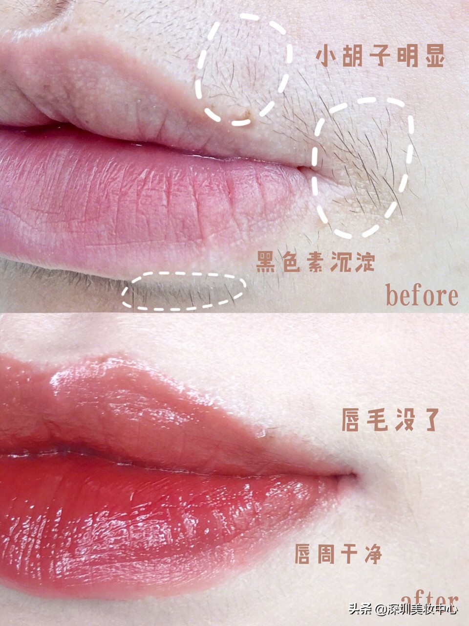 女孩如何消除嘴上的胡子,女生嘴唇去胡子妙招